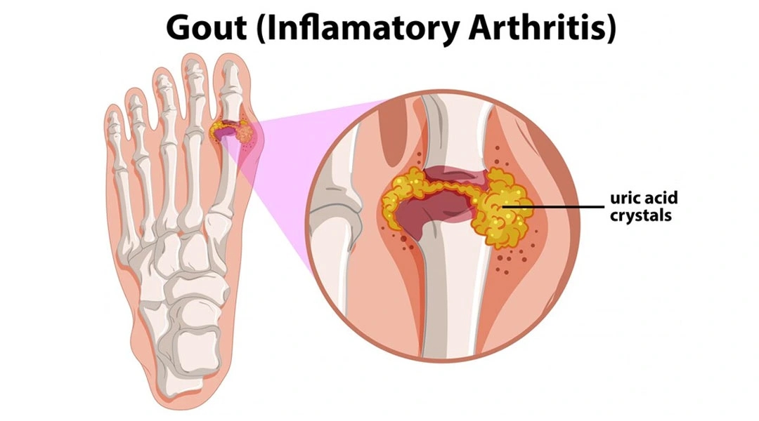 Treatments For Gout