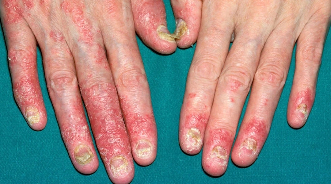 Psoriatic Arthritis (PsA)